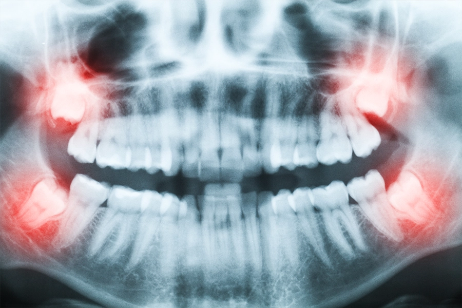 親知らずの腫れや痛みが悪化する？やってはいけないNG行動
